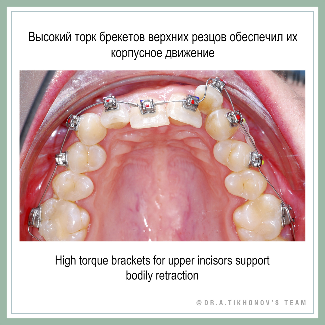 Компенсация хирургического скелетного 2 класса - ответы. - интересно об  ортодонтии, имплантации и протезировании зубов